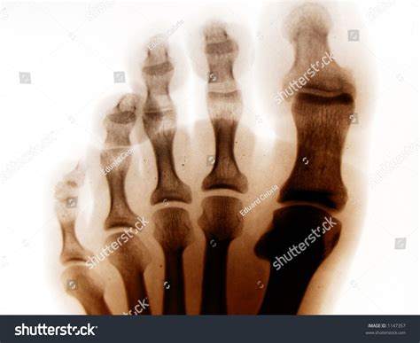 Foot Fingers Xray Stock Photo Edit Now 1147357 Shutterstock