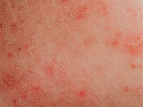 The Difference Between Rosacea Psoriasis And Eczema Readers Digest