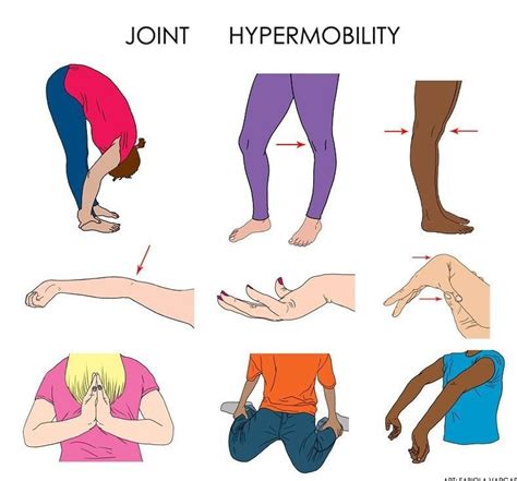 Joint Hypermobility Ehlers Danlos Syndrome Pinterest