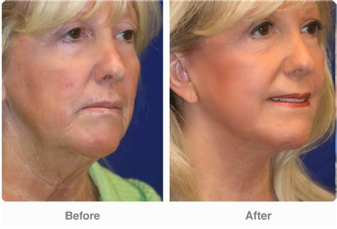 Perfect Body Laser And Aesthetics Neck Lift