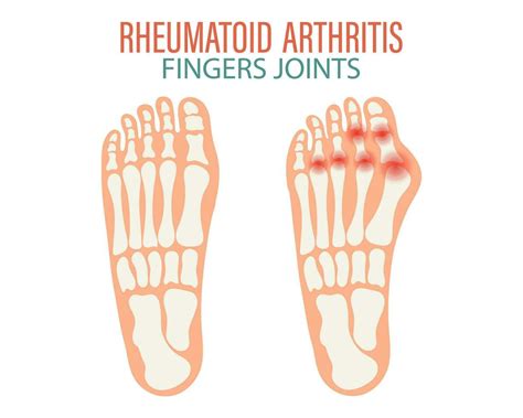 Rheumatoid Arthritis Osteoarthritis Of The Joints Of The Fingers And