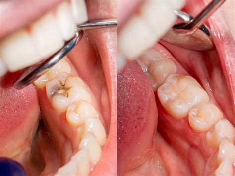 Dental Fillings In Gilroy Ca Gilroy Dental Fillings