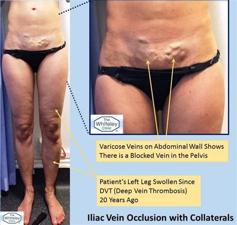 Swollen Leg From Pelvic Vein Blockage The Whiteley Clinic