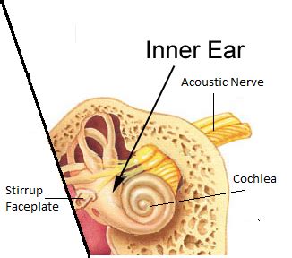 The inner ear consists of tiny bony structures filled with fluid. Hearing Loss, What is it, What Types Are There, What ...