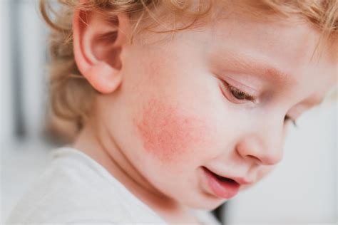 Alergia Pokarmowa U Dziecka Jakie S Objawy I Jak Leczy