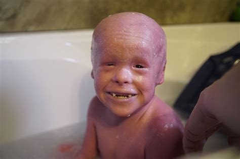 Little Boy With Rare Skin Condition Shows Life Is Always Worth Living