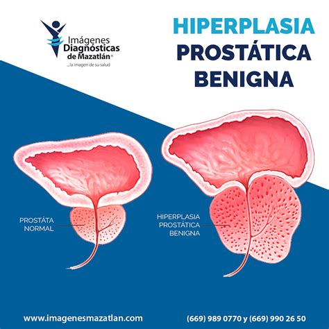 Hiperplasia Prost Tica Benigna