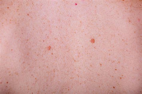 180 Closeup Brown Mole On Caucasian Woman Skin Stock Photos Pictures
