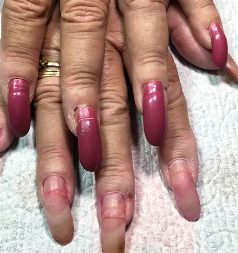 Skin Around Nails Peeling Deficiency - Nail Ftempo
