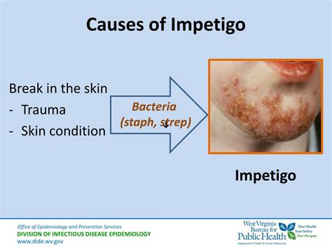 Ppt Introduction To Skin Infections For School Nurses Powerpoint