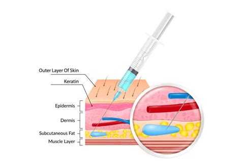 Give An Intramuscular Injection With Images Injection