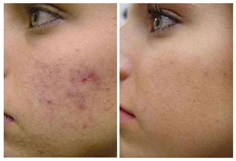 Retin A Before And After Scars Images Galleries