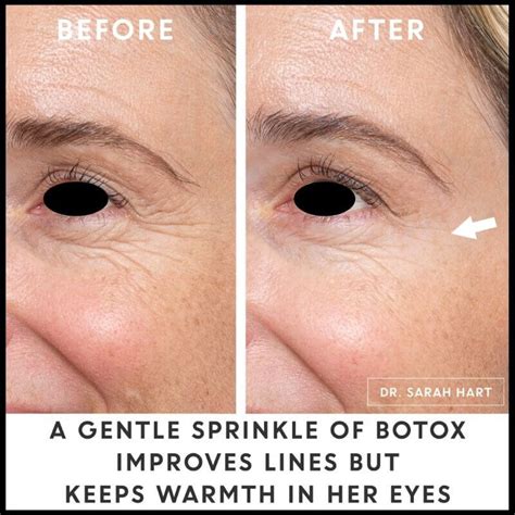 How Many Units Of Botox For Forehead First Time Cosmetic Surgery Tips