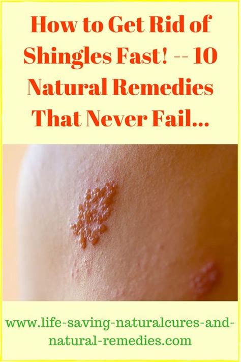 Powerful Natural Treatments And Home Remedies For Shingles Amately
