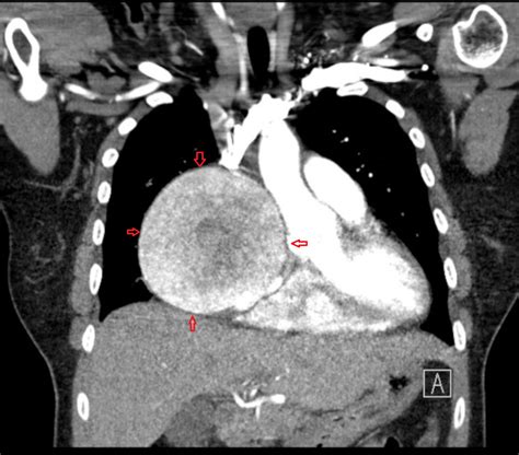 Cureus Rare Case Of Giant Asymptomatic Left Coronary Artery Aneurysm