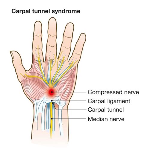 What Causes Carpal Tunnel Syndrome Catching Health With Diane Atwood