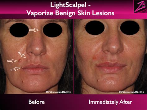 Lightscalpel Co2 Laser Removal Of Benign Skin Lesions Lightscalpel