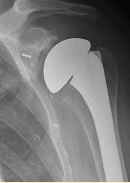 Shoulder Arthritis Joint Replacement Locked Dislocation Of A Total