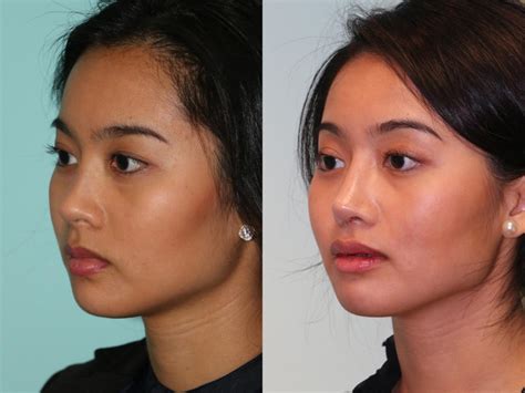 Rhinoplasty Photos Chevy Chase MD Patient