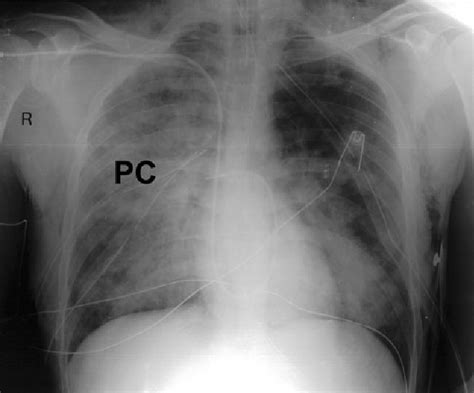 Pulmonary Contusion X Ray