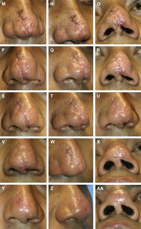 Unique Clinical Aspects Of Nasal Scarring Plastic Surgery Key