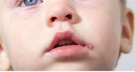 Cold Sores And Babies Can Cold Sores Harm My Child Luminance Red