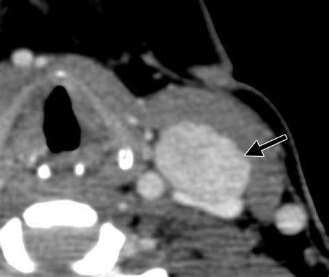 Imaging Of Ectopic Thyroid Tissue And Thyroglossal Duct Cysts Radiographics