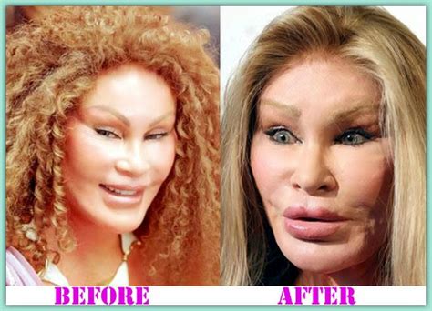 Surgery Plastic Before After Catwoman Plastic Surgery What She Did