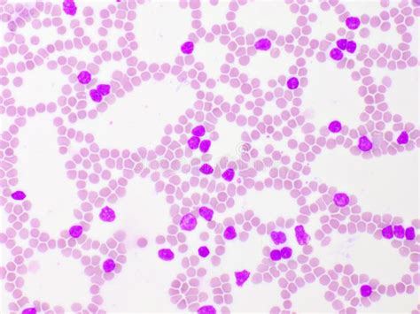 Picture Of Acute Lymphocytic Leukemia Or All Cells In Blood Smear Stock
