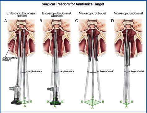Figure 4 From Evaluation Of Surgical Freedom For Microscopic And