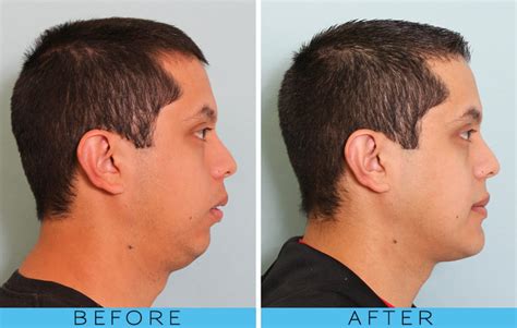We Love Our Before And Afters Oral And Maxillofacial Surgery In San