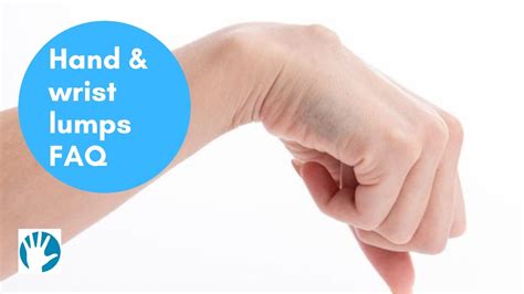 Hand And Wrist Lumps Faq Midland Hand Clinic Youtube