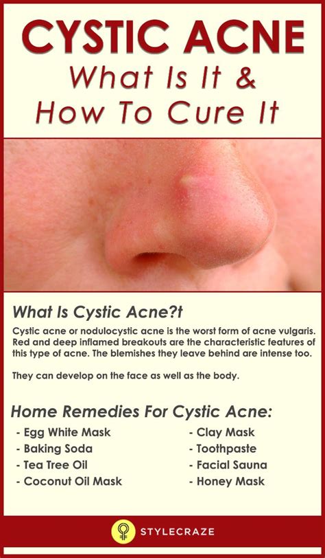 Cystic Acne What Is It And How To Heal It Cystic Acne Remedies