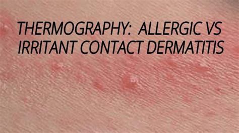 Allergic Contact Dermatitis And Irritant Contact Dermatitis