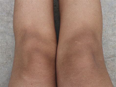 Dark Knees Causes And Home Treatment