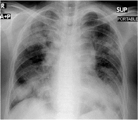 Chest X Ray Posteroanterior Pa View January 2019 Bilateral