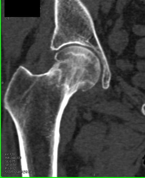Bilateral Avascular Necrosis Of The Femoral Heads Musculoskeletal My