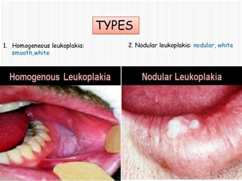 Common Oral Lesions By Ravindra Daggupati