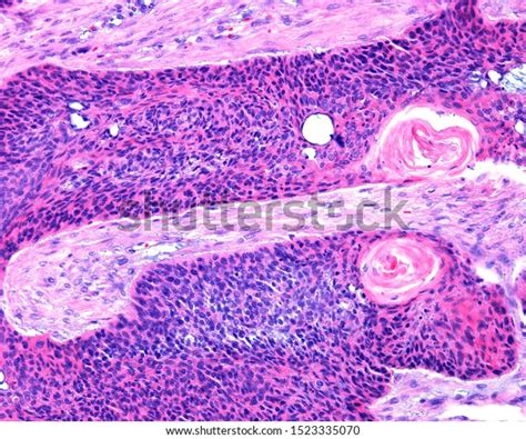 Squamous Cell Carcinoma Scc Epidermoid Carcinoma Stock Photo 1523335070