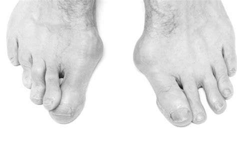 Hammer Toes Understanding And Treating The Condition