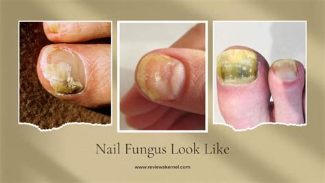 Different Types Of Nail Fungus And Their Symptoms