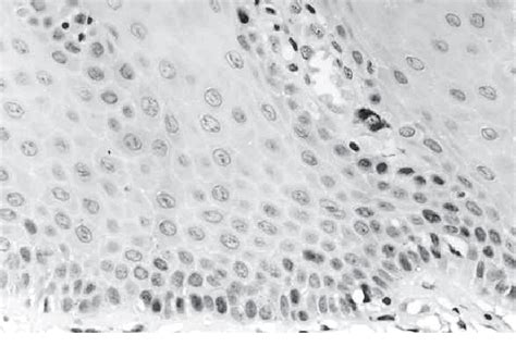 Figure 1 From Pcna And P53 Expression In Oral Leukoplakia With