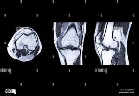 Mri Knee Joint Or Magnetic Resonance Imaging Compare Axial Coronal And