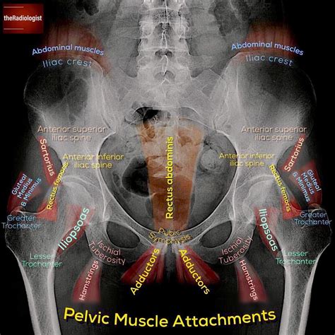 👨‍💻pelvic Muscle Attachments ⠀⠀⠀⠀⠀⠀⠀⠀⠀ A Classic Exam Question