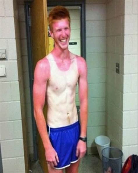 The 12 Worst Sunburns In History