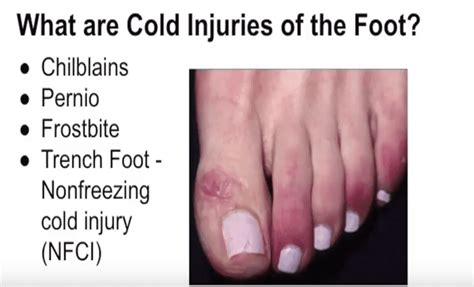 Cold Injuries Causes And Treatments Central Massachusetts Podiatry