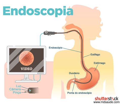 Como é feita a Endoscopia digestiva alta EDA MD Saúde