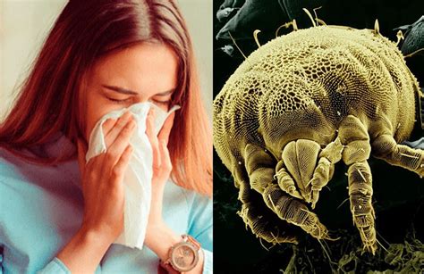 Curas Para Las Alergias Que Provocan Los ácaros Del Polvo La 100