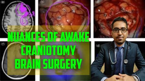 Nuances Of Awake Craniotomy Brain Surgery Neurosurgery Lecture By Dr