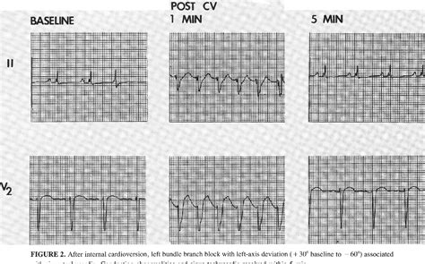 Figure 2 From Electrocardiography Electrocardiographic Changes After